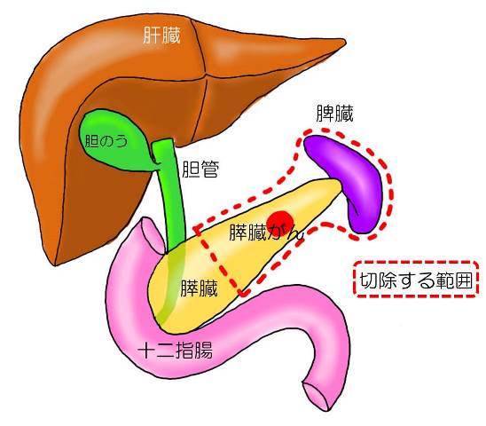 膵臓の手術について 国立がん研究センター 東病院