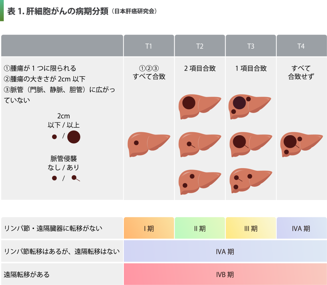 肝細胞がんの病期分類の図