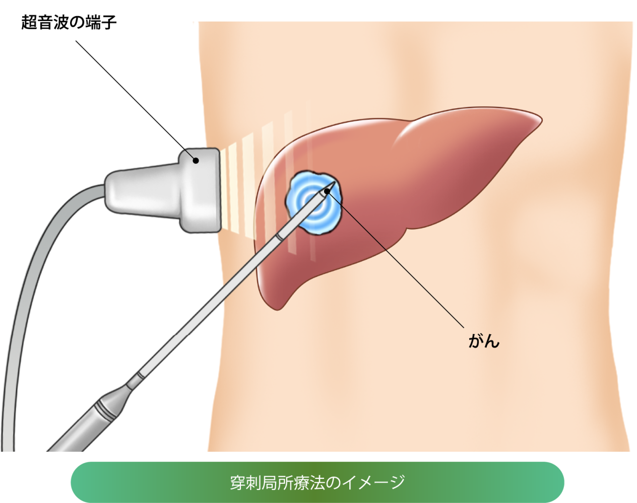 穿刺（せんし）局所療法の画像