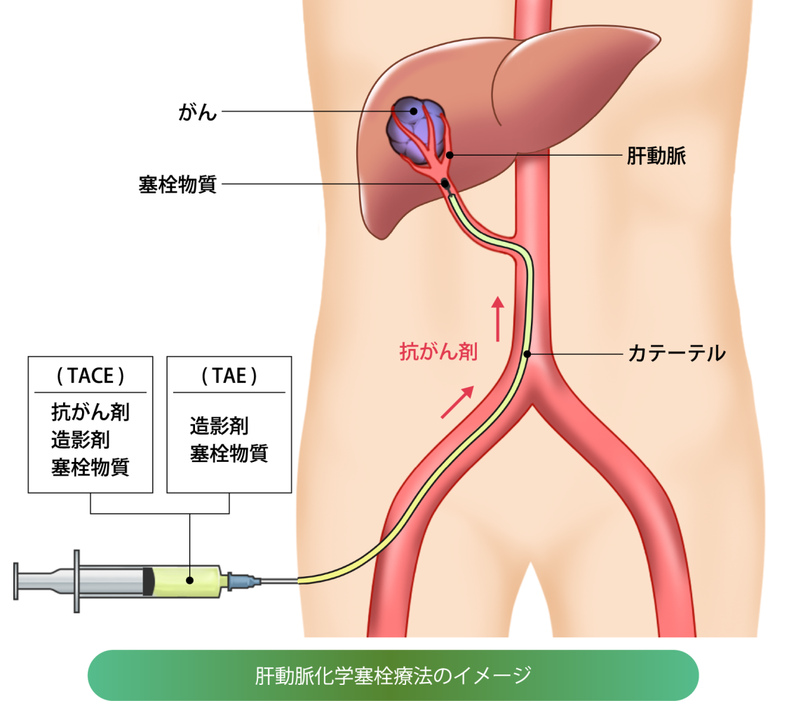 肝動脈化学塞栓療法の画像