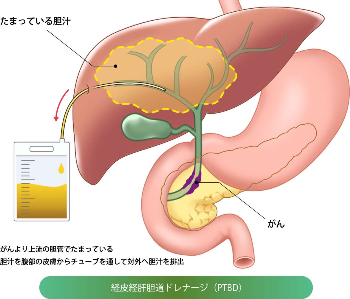 経皮経肝胆道ドレナージ（PTBD）の画像