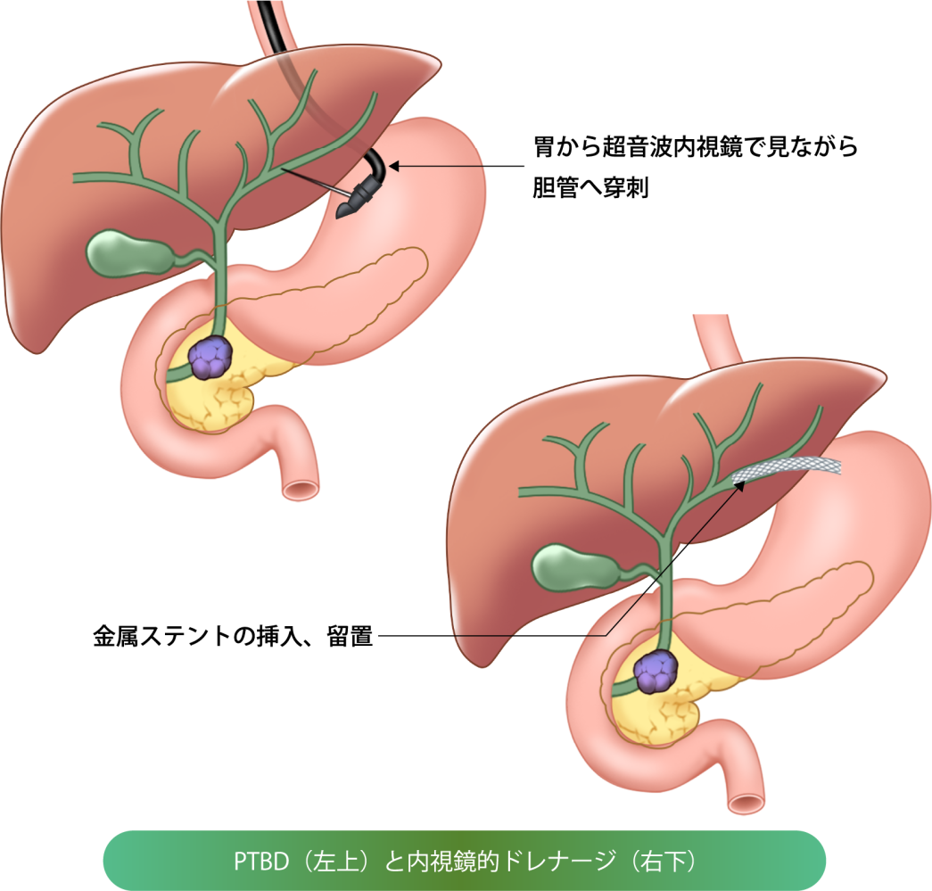 超音波内視鏡下胆道ドレナージ(EUS-BD)の画像