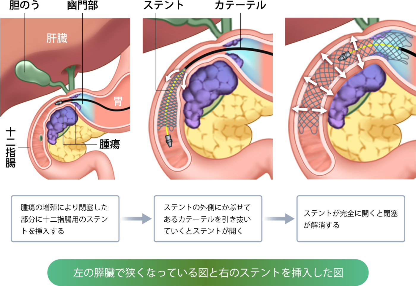 十二指腸閉塞の画像