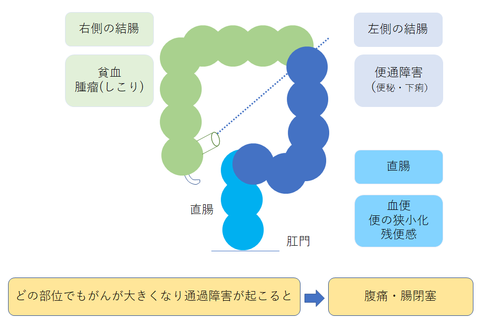 癌 症状 大腸 手遅れ