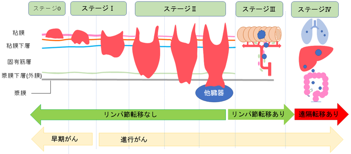 が 進行 大腸 速度 ん