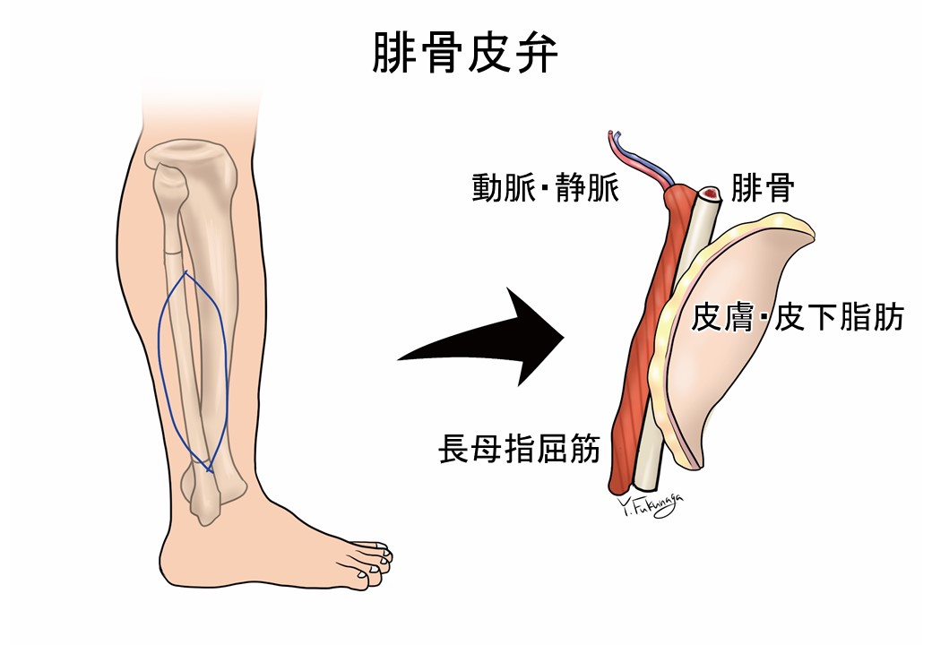 腓骨皮弁の図