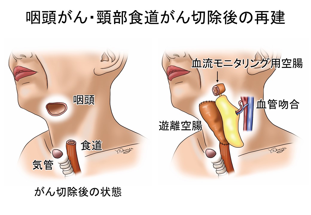 咽頭がん・頸部食道がん切除後の再建の図