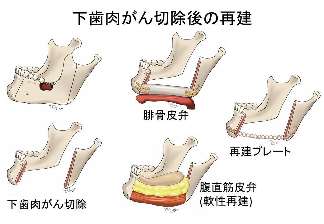 下歯肉がん切除後の再建の図