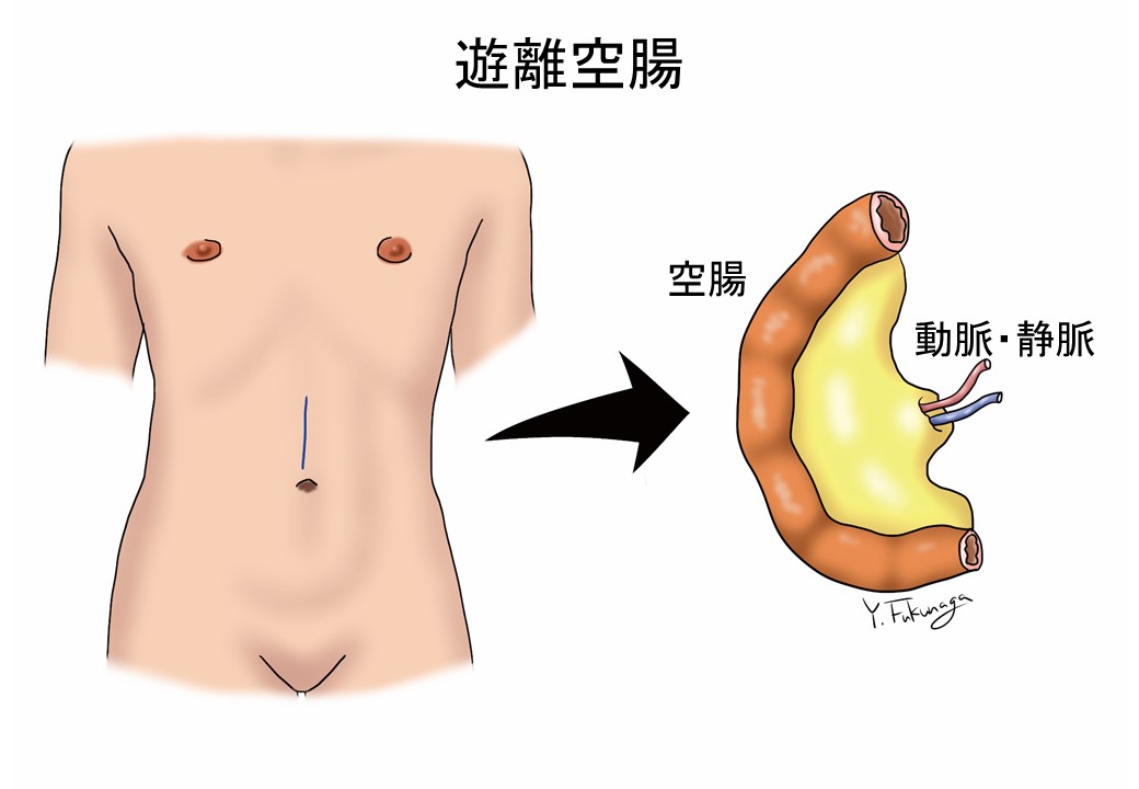 遊離空腸の図
