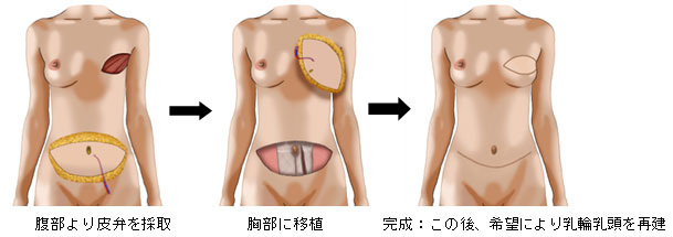 乳房再建術について 国立がん研究センター 東病院