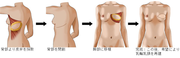 広背筋皮弁法