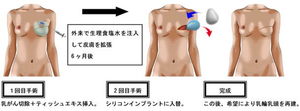 シリコンインプラントによる乳房再建の流れ