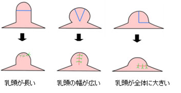 乳輪乳頭再建の利点