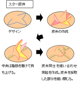 スター皮弁