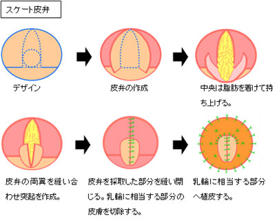 スケート皮弁