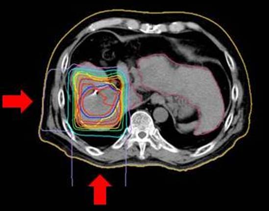 肝臓がんの陽子線治療　図