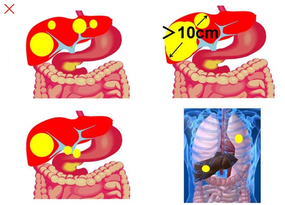 陽子線治療の適応にならない肝臓がん　図