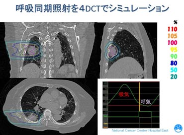 画像3 4DCT画像による陽子線治療のシミュレーション例