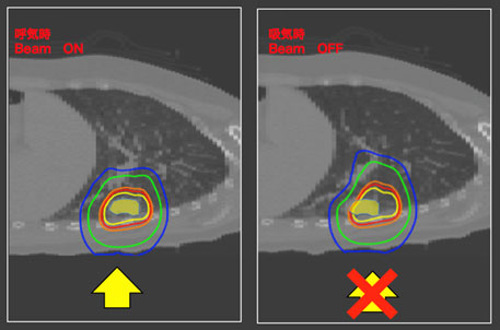 呼吸により動くがんを「待ち伏せる」技術（呼吸同期照射） 図