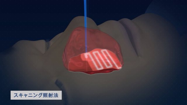 陽子線治療の概要 国立がん研究センター 東病院