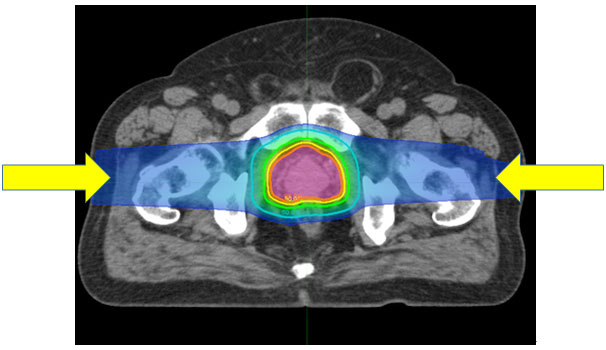 図1．前立腺がんに対する陽子線治療の一例