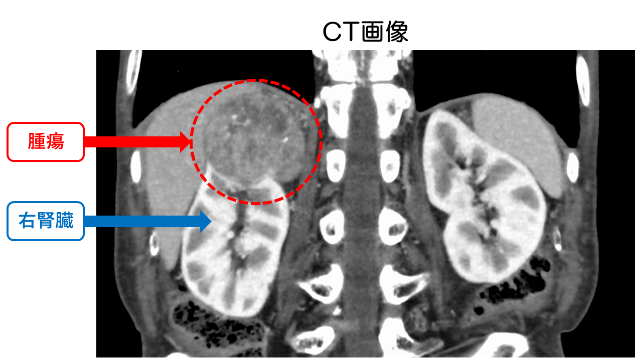 CT画像