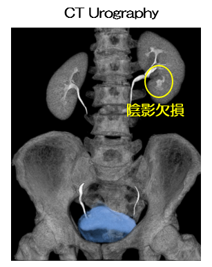 CT Urography