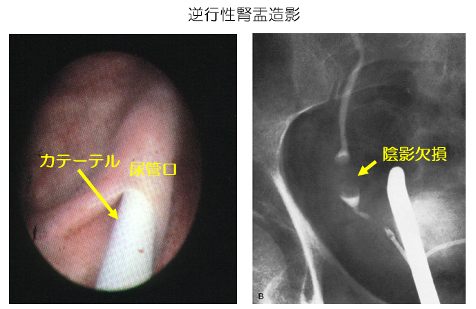 逆行性腎盂造影の画像