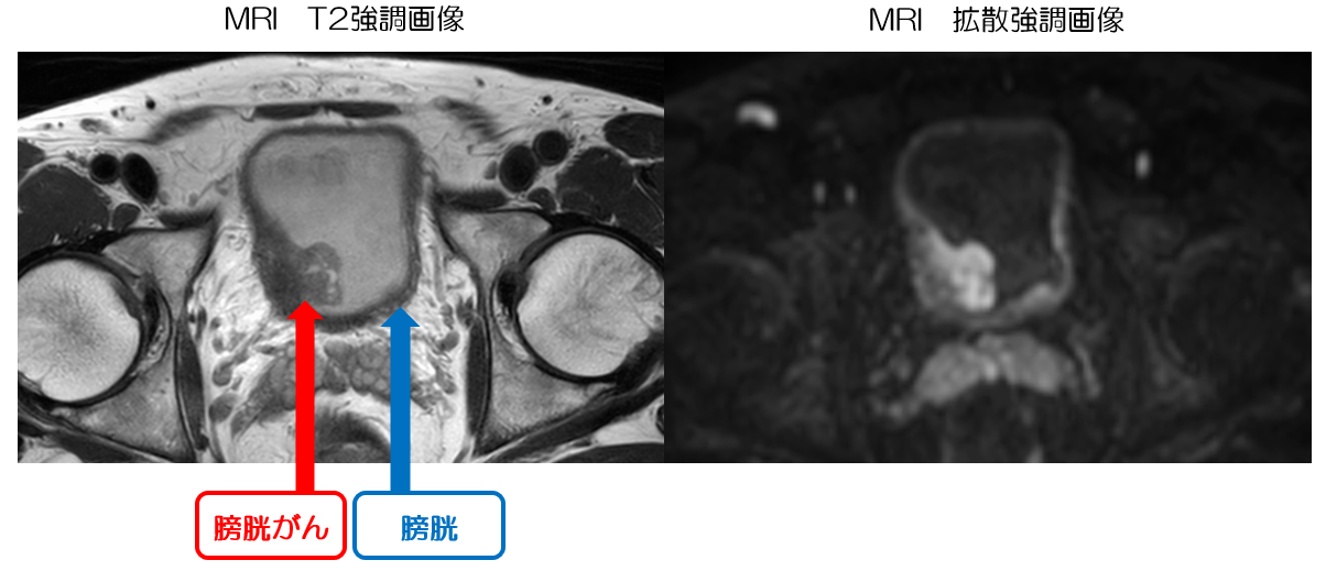 MRIの画像