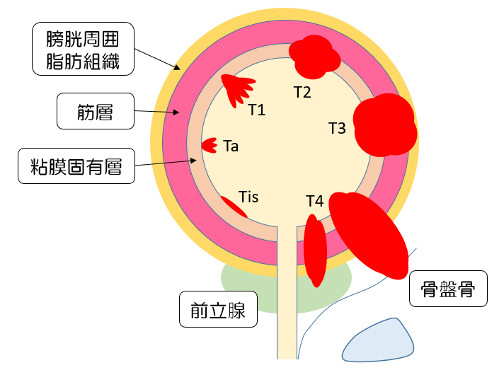 膀胱がんの進行度の図