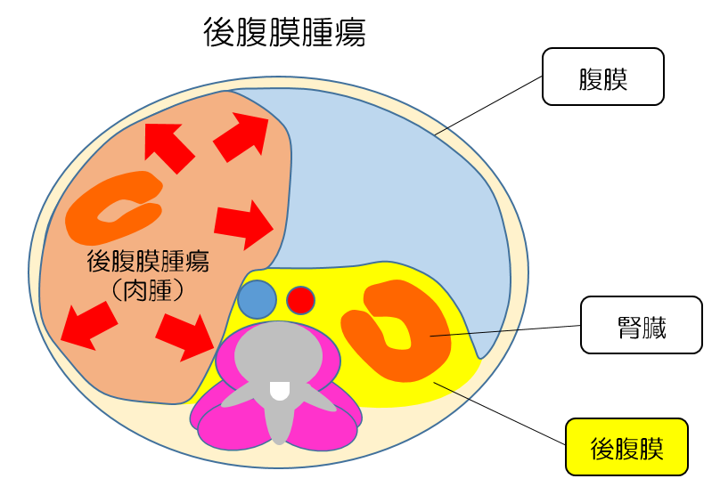 後腹膜腫瘍