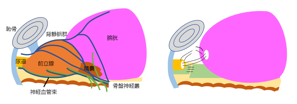 立腺全摘除術のイメージ