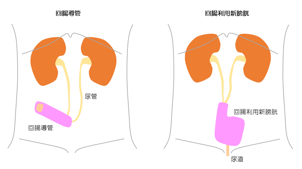 回腸導管 回腸利用新膀胱