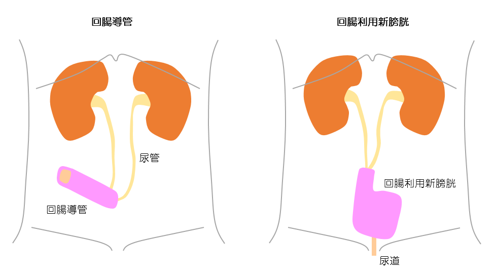 回腸導管　回腸利用新膀胱