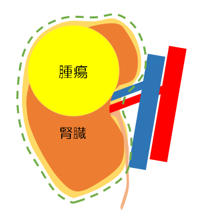 腎摘除術のイメージ