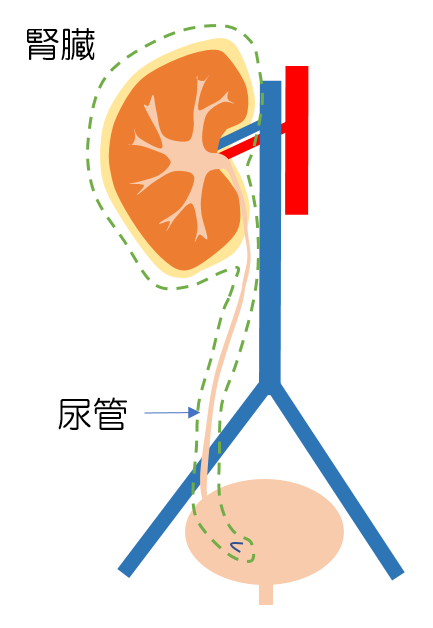 腎尿管全摘除術のイメージ