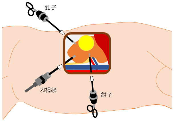 腹腔鏡手術のイラスト