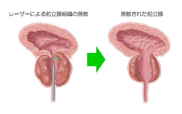 レーザーによる前立線組織の蒸散から蒸散された前立腺の画像