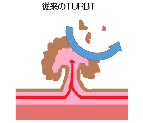 従来のTURBT