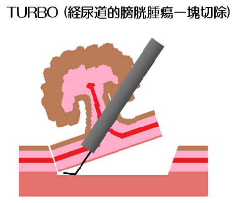 TURBO（経尿道的膀胱腫瘍一塊切除）