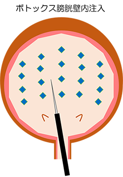 ボトックス膀胱壁内注入