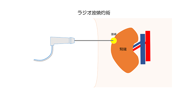 ラジオ波焼灼術のイラスト