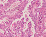 肺腺癌組織画像