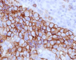 B細胞性悪性リンパ腫画像