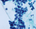 肺小細胞癌画像