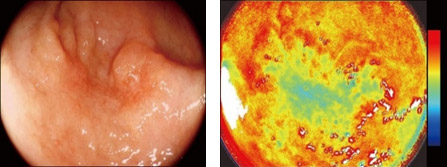 図2.早期胃がん患者における白色光画像（左図）と 酸素飽和度イメージングの内視鏡画像（右図）