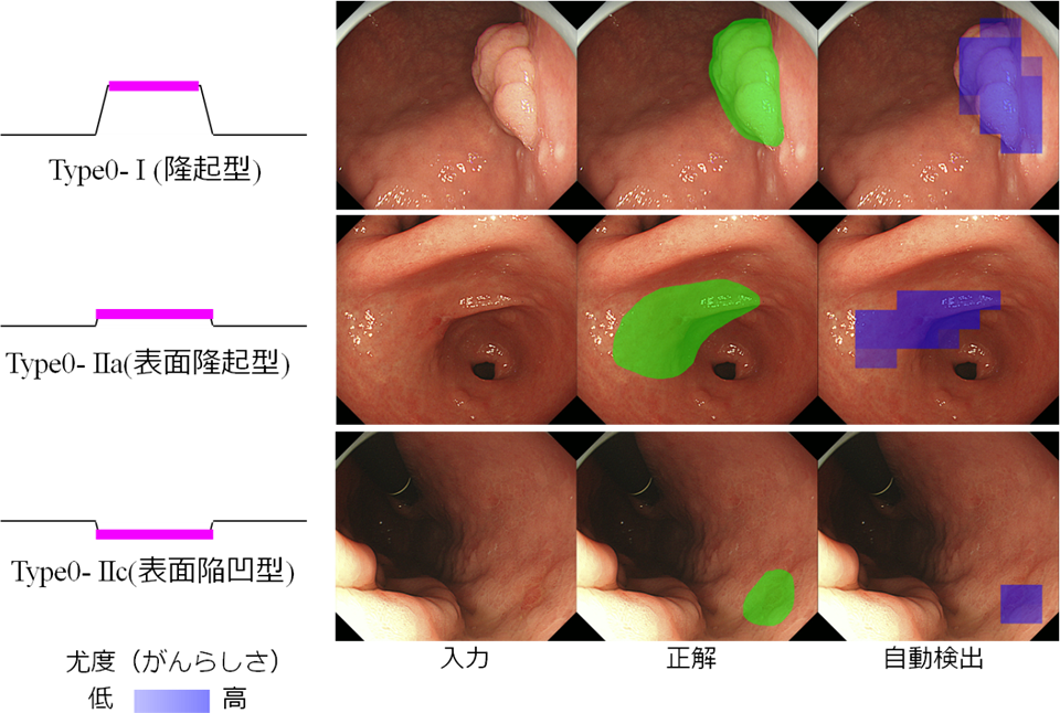 タイプ別の早期胃がんの自動検出例（図）