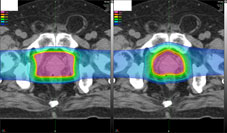 前立腺がんの線量分布例