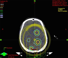 脳腫瘍に対する定位放射線治療
