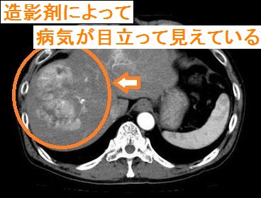 Ct 造影